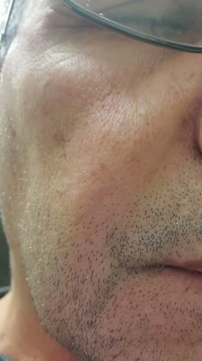 Fasciculation of the angle of the mouth