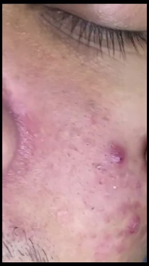 pimplepoppersatisfying su TikTok