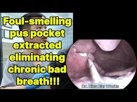 Foul smelling pus pocket extracted eliminating chr | ear cleaning | ASMR earwax | soothing |relax|