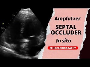 Amplatzer device in situ with right ventricle dilation #cardiology #echo #echocardiography