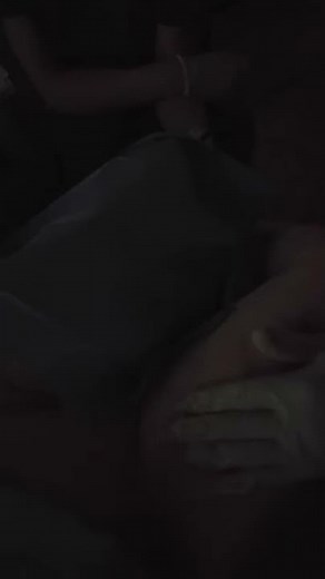 Renuvion (J-Plasma) skin and tissue tightening of the arms