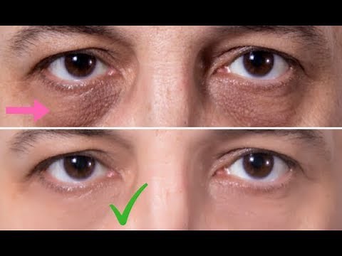 3 Exercise Routines to Get Rid of Eyebags – Eye Bag Removal at Home