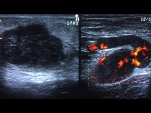 Ultrasonography Tutorial- Breast Lump video