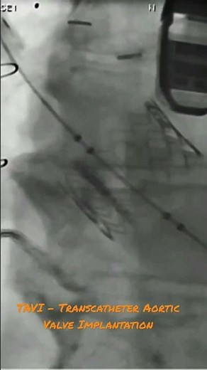 TAVI - Transcather Aortic Valve implantation - Edward sapien