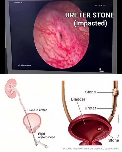Ureteroscopy with laser lithotripsy - 37 year old female with right distal Ureter stone blocking urine flow. She presented with right flank pain and blood in urine. - used to break up kidney stones by that were not passed and remain lodged in the ureter. - During this procedure a laser beam is applied directly to the stone to break it into small pieces and passed easily. #kidneystones #ureteroscopy #kidneydisease #kidneyhealth