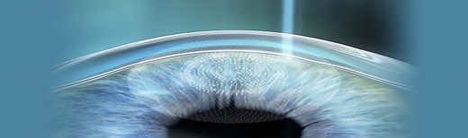 SMILE LASIK NYC | SMILE Laser Eye Surgery Manhattan New York