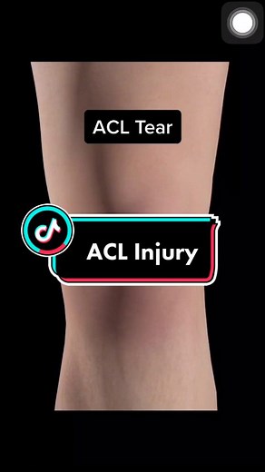ACL Injury Animation: Understanding the Tear