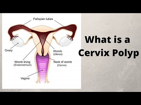 What is a Cervix Polyp