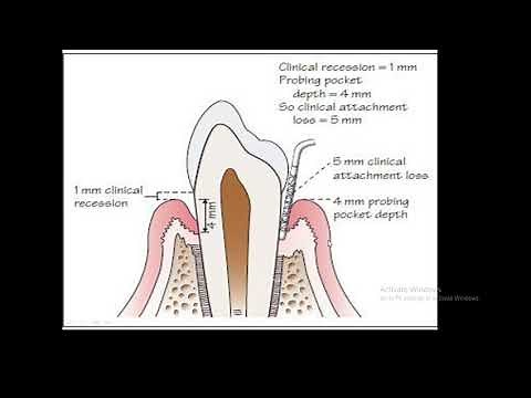 How to calculate the total attachment loss?(OSCE)