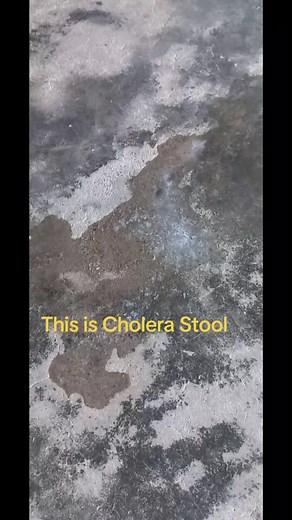 Understanding Cholera Stool: Key Characteristics Explained