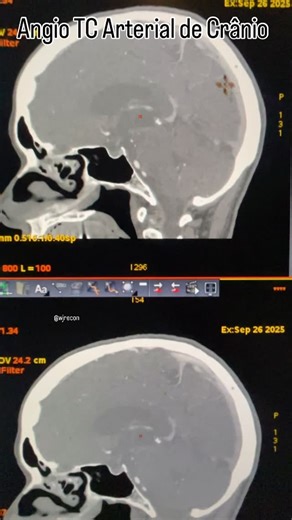 @WJRecon on Instagram: "A Angio-TC de artérias cerebrais permite avaliar vasos intracranianos e identificar aneurismas. A reconstrução 3D em VR/VRT (Volume Rendering) gera imagens volumétricas realistas. No caso descrito: aneurisma no segmento M2 da artéria cerebral média esquerda. #ct #3d #tomografia #imaginologia #ct #biomedicina #medicina #vitrea #canon #casosclinicos #radiologia #radiology #3dreconstruction #globalillumination #coração #arteriacoronaria #coracao #coronaria #radiologiaporamor