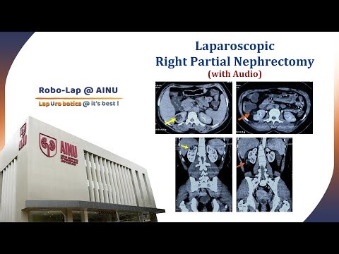 Laparoscopic Right Partial Nephrectomy with Audio | RoboLap@AINU 2025