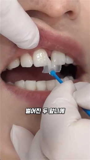 How to Close Front Teeth Gaps Without Braces