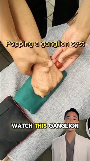 Popping a cyst with bare hands!