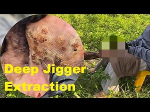 💥🦶 Deep Jigger Extraction | Intense Foot Cleaning Therapy #GY614