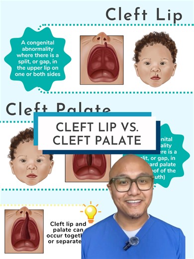 Next up, let's talk about cleft lip and cleft palate! These are birth defects where there is a split (or gap) in either the lip or the hard palate of the mouth. In cleft lip, the split happens in the upper lip on one or both sides. This is the most commonly seen birth defect in the US. In cleft palate, the split occurs in the hard palate - the roof of the mouth. Cleft lip and cleft palate can occur together OR separately! These gaps make it hard for the infant to swallow normally...so as nurses,