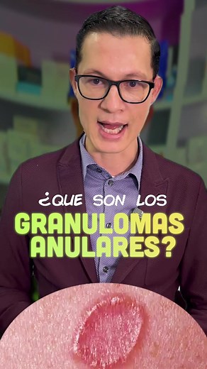 Granulomas Anulares: Causas, Síntomas y Tratamientos