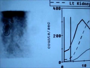 DTPA Kidney Scan, Why It Is Required ?