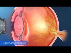 Ellex Laser Floater Treatment animation