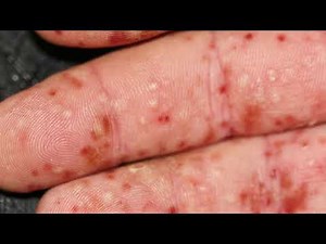 Pustular psoriasis: pictures on feet, images, palmoplantar and generalized, photos localized