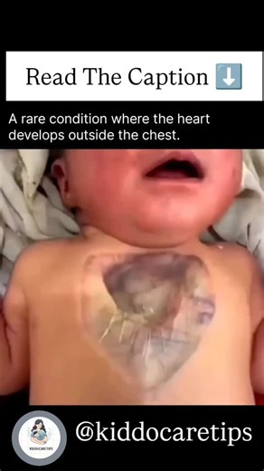 kiddocaretips on Instagram: "A rare condition where the heart develops outside the chest is called Ectopia Cordis ❤️‍🩹 It’s an extremely uncommon congenital birth defect in which the baby’s heart is located partially or completely outside the chest cavity. This happens very early in pregnancy when the chest wall doesn’t form properly, leaving the heart exposed. Ectopia cordis is often associated with other serious abnormalities, such as defects in the sternum, abdominal wall, diaphragm, or even