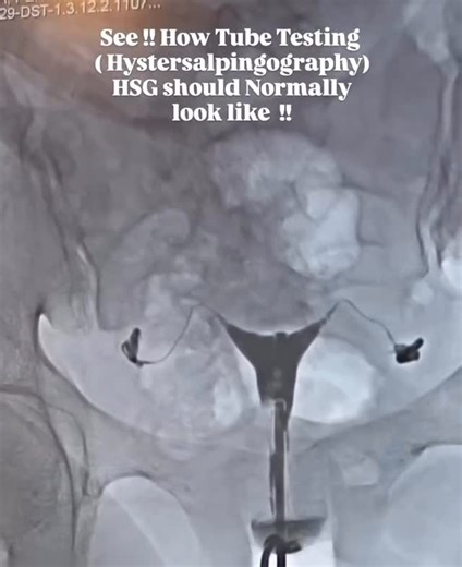 @medgrindfit_ on Instagram: "Curious about how a normal HSG (Hysterosalpingography) should look? > This X-ray image beautifully demonstrates the appearance of a healthy, patent uterine cavity and fallopian tubes during a tube test. In a normal HSG, the dye flows freely through the uterus and spills out of both fallopian tubes, confirming their openness-a critical step in evaluating female fertility.For so many women, HSG is an important investigation, especially when facing difficulty in conceiv
