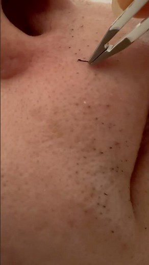 Tweezing Upper Lip Hairs: Oddly Calming and Satisfying#hairremoval