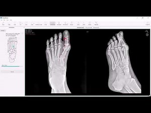 Hallux Valgus: Quickly plan the surgery