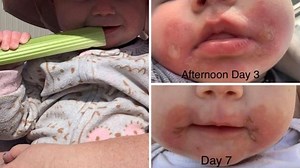Mum’s warning to all parents after baby suffers ‘margarita burn’ from eating celery