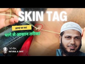 "Skin Tag Removal at Home | Easy & Safe Method | Skin Warts Treatment Naturally"