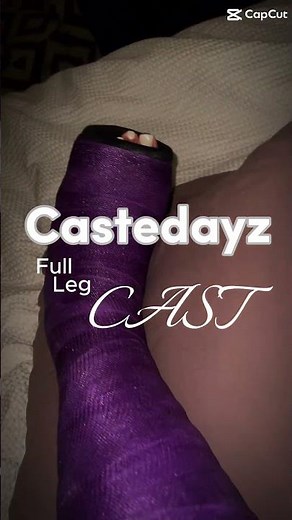 Purple Long leg cast #broken #legcast #pretty #nails