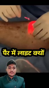 Endovenous laser treatment #endovenouslaserablation #varicoseveins | Yogesh Kumar