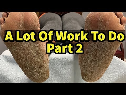 A Lot Of Work To Do, Part 2: Thick Calluses And Severely Dry Skin