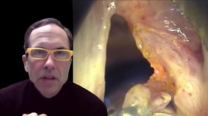 Laryngoscopy | Voice Doctor