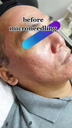 Achieve Flawless Skin with Microneedling Before And After Videos
