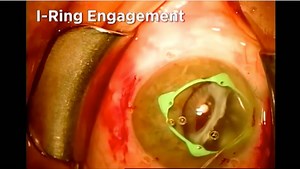 IOL Exchange in PXF-related IOL and Lens Capsule Dislocation - Eyetube
