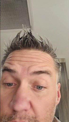 Exploding Camp Stove burns hair, eyebrows, eyelashes & skin #camping #fire @Colemancampfire