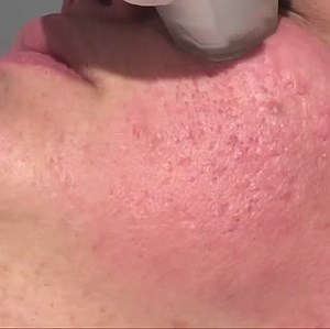 Fractional RF Laser uses the combination of heat and micro-needles to resurface the skin with textural problems and stimulates collagen production reducing the appearance of acne scarring, open pores and fine lines. Book your complimentary consultation today. Explore resultslaserclinic.com.au/winter-sale-2019/ Message us to book Call 1300 722 432 | Results Laser Clinic