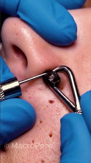 4K Macro Nose Pore Cleaning | Real Dermatology