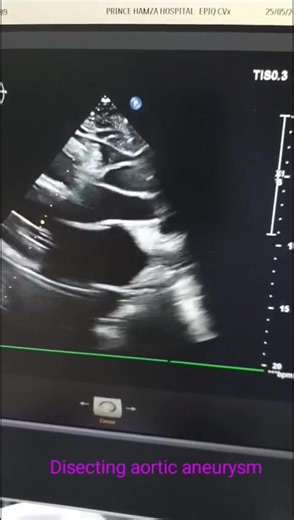 27K views · 223 reactions | Aortic Dissection ---- A dissecting...