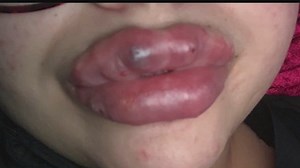Video shows procedure done to take product out of people with bad lip injections