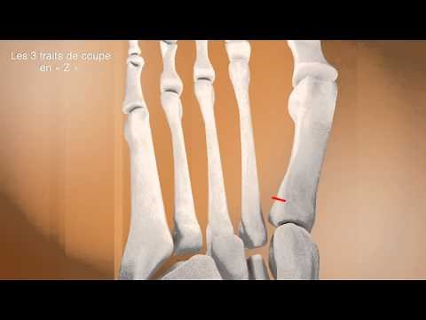 7 L'ostéotomie de SCARF - Dr. Coillard | Dr. Boublil | Dr. Grisard -