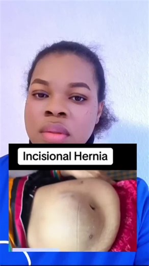 incisional hernia happens when the abdominal wall becomes weak where the surgery was done, and tissue pushes through that weak spot.#fyppppppppppppppppppppppp #nurseify #incisionalhernia