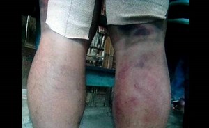 Manipur Teacher Thrashed For Allegedly Caning Student, Hospitalised