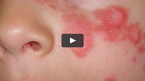 Lupus Diagnosis - Dr. Joel Wallach