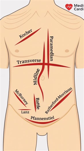 Medicine/Cardiology on Instagram: "A quick overview of the most commonly used abdominal surgical incisions — each chosen based on exposure, underlying pathology, and surgeon preference. From Kocher to Pfannenstiel, every incision provides unique access and plays a crucial role in safe and effective surgical practice. A must-know map for medical students, interns, and anyone in surgical training. 🩺✂️ ⸻ 🔖 Hashtags #MedicooCardioo #Surgery #SurgicalIncisions #GeneralSurgery #MedicalEducation #Sur