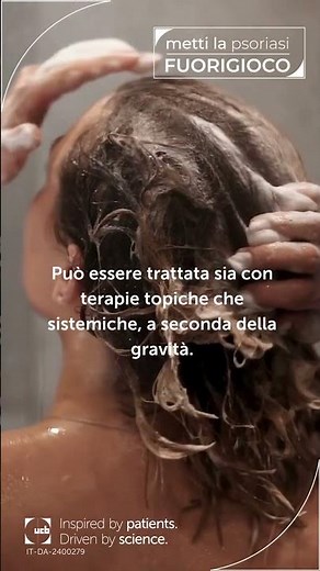 Psoriasi del cuoio capelluto: sintomi e rimedi