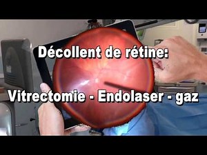 Décollement de rétine vitrectomie endolaser gaz Dr Pierre-André DUVAL
