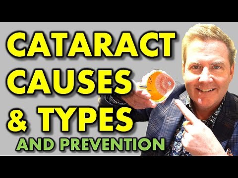 WHAT CAUSES CATARACT & HOW TO PREVENT CATARACTS: youtube eye doctor optometrist explains