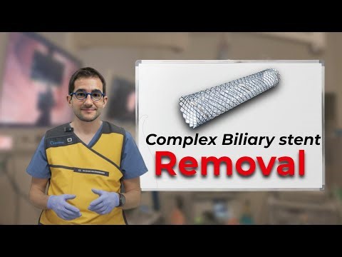 How to retrieve a challenging biliary stent?